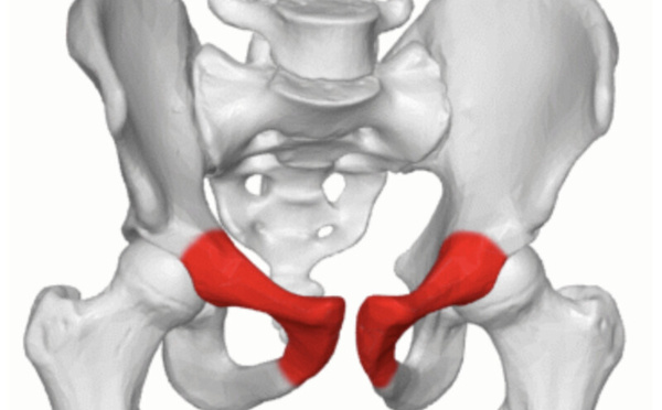 Pubalgie et sport : fini les protocoles standards, place à l’exercice sur mesure