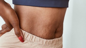 Des conseils pour atténuer les vergetures Des conseils pour atténuer les vergetures