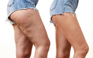 Comment éviter la cellulite ? Comment éviter la cellulite ?