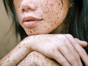 Soleil : Comment échapper aux tâches brunes ? Soleil : Comment échapper aux tâches brunes ?