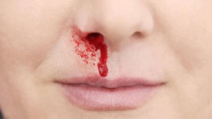 Saignement du nez : Attention à la chaleur et à l’air conditionné Saignement du nez : Attention à la chaleur et à l’air conditionné