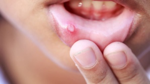 Aphtes : Remèdes naturels pour s'en débarrasser Aphtes : Remèdes naturels pour s'en débarrasser