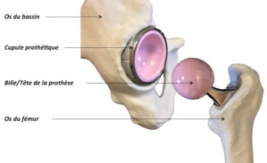 Le remplacement total de la hanche se fait en ambulatoire dans les pays du Maghreb Le remplacement total de la hanche se fait en ambulatoire dans les pays du Maghreb