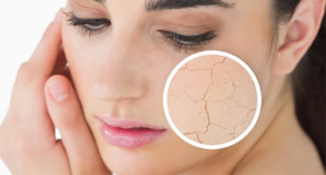 Peau sèche : que faire pour rester hydraté ? Peau sèche : que faire pour rester hydraté ?