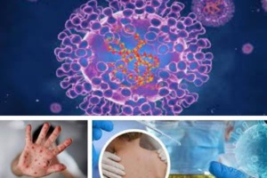 Variole du singe : les cas se multiplient à travers le monde Variole du singe : les cas se multiplient à travers le monde