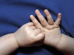 Grippe de la tomate ? Grippe de la tomate ?