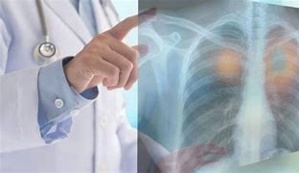 Pollution : La compréhension du cancer du poumon fait une avancée majeure Pollution : La compréhension du cancer du poumon fait une avancée majeure