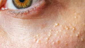 Grains de milium : l'astuce pour s'en débarrasser Grains de milium : l'astuce pour s'en débarrasser