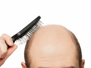 La consommation excessive de boissons sucrées serait l’une des causes de la calvitie La consommation excessive de boissons sucrées serait l’une des causes de la calvitie