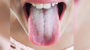 Pourquoi a-t-on parfois la langue blanche ?