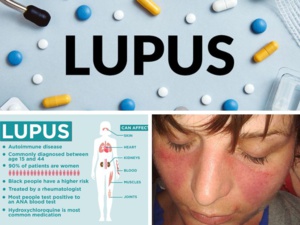 Le lupus, une maladie chronique auto-immune que l'on ne sait malheureusement pas guérir Le lupus, une maladie chronique auto-immune que l'on ne sait malheureusement pas guérir