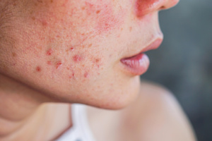 Rosacée : une maladie énigmatique de la peau