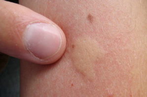 Nos amis les insectes sont parmi nous : que faire en cas de piqûre ? Nos amis les insectes sont parmi nous : que faire en cas de piqûre ?