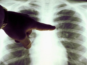 La tuberculose est encore persistante au Maroc