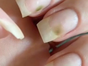 Le syndrome des ongles verts ? Le syndrome des ongles verts ?
