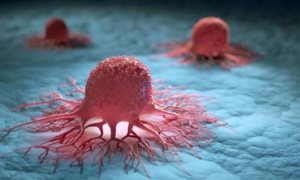 Cancer : l'OMS alerte sur une explosion des cas à l'horizon 2050