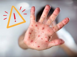 La rougeole fait son retour à Agadir