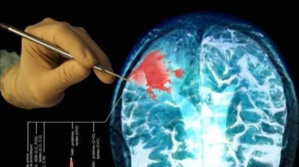 L'IA à la pointe du combat contre le cancer au Royaume-Uni L'IA à la pointe du combat contre le cancer au Royaume-Uni