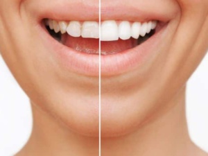 Les traitements esthétiques dentaires Les traitements esthétiques dentaires