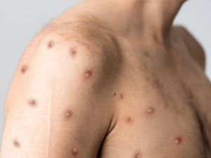 Variole du singe : Quel risque pour le Maroc avec un premier cas en Europe ? Variole du singe : Quel risque pour le Maroc avec un premier cas en Europe ?