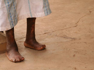 La lèpre persiste au Maroc : 14 nouveaux cas détectés La lèpre persiste au Maroc : 14 nouveaux cas détectés