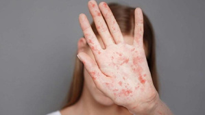 Rougeole à l’école : quarantaine obligatoire, l'État serre la vis