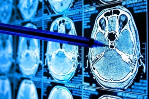 Une IA révolutionnaire détecte le cancer avec une précision inédite Une IA révolutionnaire détecte le cancer avec une précision inédite