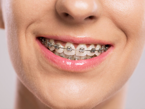 L’orthodontie chez les seniors : l’âge du métal est-il passé ? L’orthodontie chez les seniors : l’âge du métal est-il passé ?