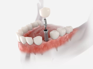 Les prothèses dentaires intelligentes : vers une bouche connectée ?