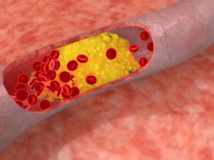 Le plus grand fauteur de troubles dans une ville (votre corps), c’est le cholestérol. Le plus grand fauteur de troubles dans une ville (votre corps), c’est le cholestérol.