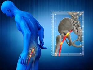 Entretien : La sciatique expliquée par un rhumatologue Entretien : La sciatique expliquée par un rhumatologue
