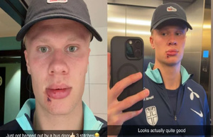 Haaland blessé au visage dans un incident insolite avec la sélection norvégienne Haaland blessé au visage dans un incident insolite avec la sélection norvégienne