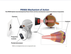« Rendre la vue » n’est plus un rêve : l’implant rétinien qui redonne une vision centrale aux patients DMLA « Rendre la vue » n’est plus un rêve : l’implant rétinien qui redonne une vision centrale aux patients DMLA