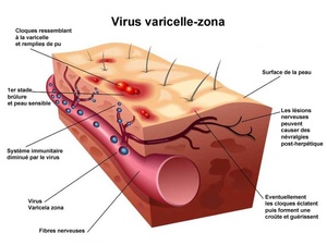 Le Zona : quand un virus endormi se réveille et transforme le corps en champ de bataille Le Zona : quand un virus endormi se réveille et transforme le corps en champ de bataille