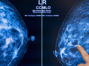 L’IA prédit le risque de cancer du sein plusieurs années à l’avance