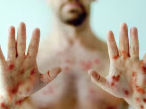 Mpox à New York : un seul cas, mais un signal que la santé publique ne peut pas traiter à la légère Mpox à New York : un seul cas, mais un signal que la santé publique ne peut pas traiter à la légère