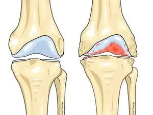 Traitement de l’arthrose : des résultats prometteurs pour une solution durable