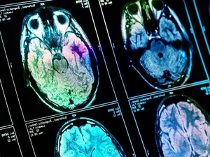 Une glycémie élevée pourrait accélérer le vieillissement du cerveau, selon une étude