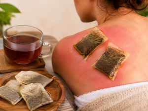 Coup de soleil : cette astuce au thé noir pourrait bien vous surprendre