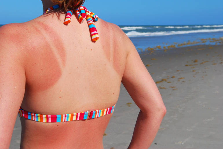 Bronzage : comment en profiter cet été sans se brûler la peau ?
