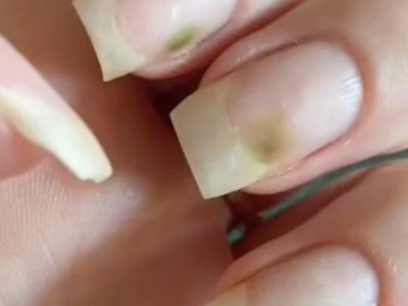Le syndrome des ongles verts ?