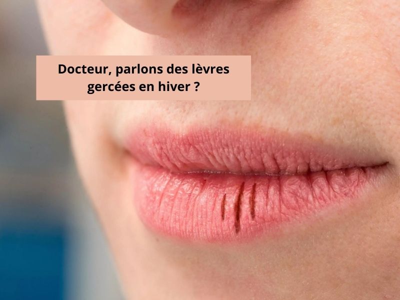 Docteur, parlons des lèvres gercées en hiver ?