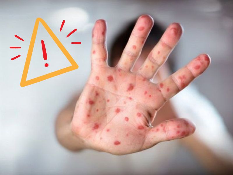 La rougeole fait son retour à Agadir