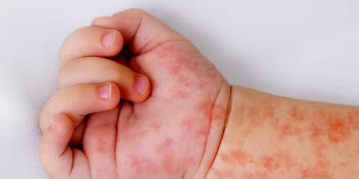 Rougeole au Maroc : retour d'une menace oubliée