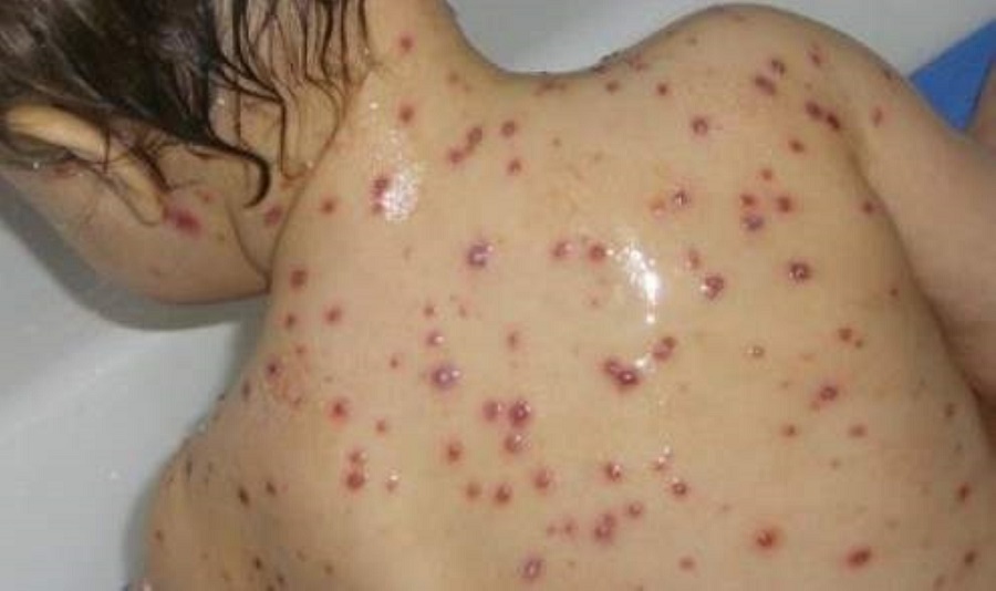 Rougeole à Chichaoua : Mobilisation générale des autorités pour sauver les enfants