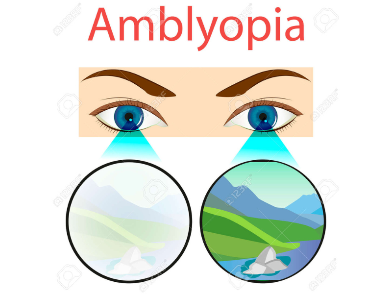 L’œil paresseux : et si votre cerveau faisait la sieste d’un seul côté ?