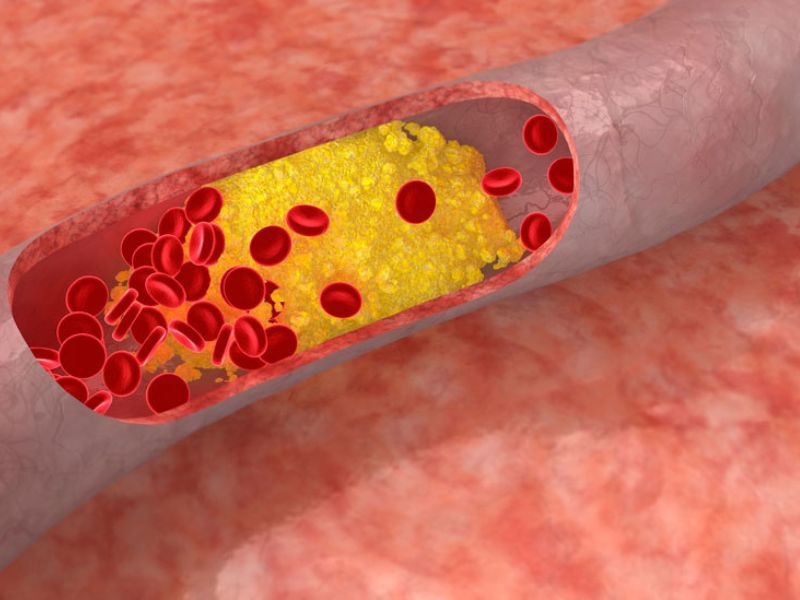 Le plus grand fauteur de troubles dans une ville (votre corps), c’est le cholestérol.