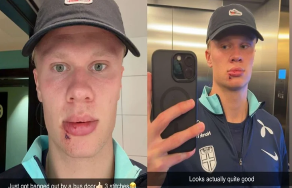 Haaland blessé au visage dans un incident insolite avec la sélection norvégienne