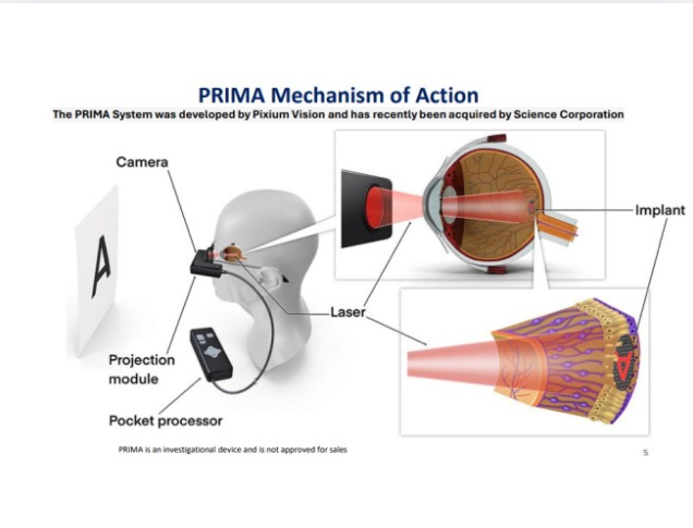 « Rendre la vue » n’est plus un rêve : l’implant rétinien qui redonne une vision centrale aux patients DMLA