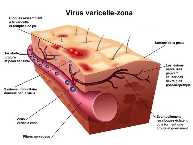 Le Zona : quand un virus endormi se réveille et transforme le corps en champ de bataille